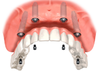 オールオンフォー(All-on-4)とは？