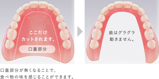 口蓋部分が無くなることで食べ物の味を感じることができます。