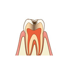 虫歯・不良補綴