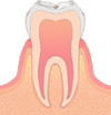 CO …初期虫歯