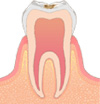 C1 …エナメル質虫歯