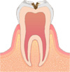 C2 …象牙質虫歯
