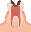 C3 …歯髄に達した虫歯