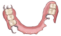 部分入れ歯