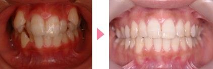 がたがた（叢生）の矯正治療例