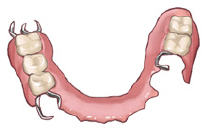 部分入れ歯の特徴