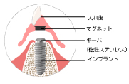 自費の部分入れ歯