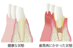 STEP.3歯石取り(スケ－リング) 