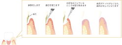STEP.4歯周外科治療