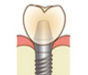 インプラントの費用