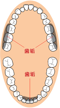 歯石は歯磨きだけでは取り除けません