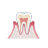 歯肉炎・歯周病とは