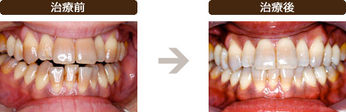 ホームホワイトニングの治療前と治療後