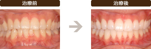 ホームホワイトニングの治療前と治療後