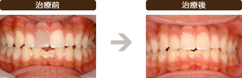 ウォーキングブリーチ（神経を抜いた歯のホワイトニング）の治療前と治療後