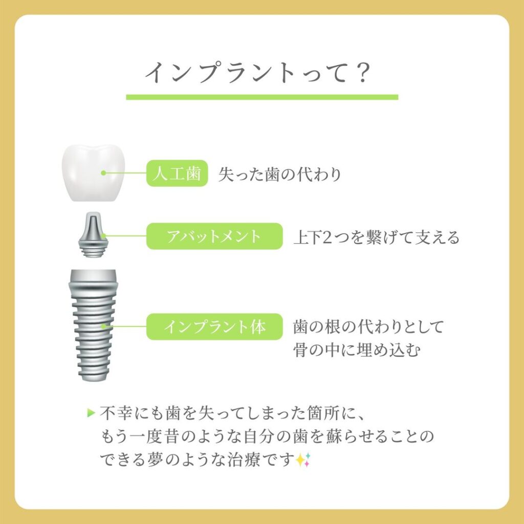 インプラントって？