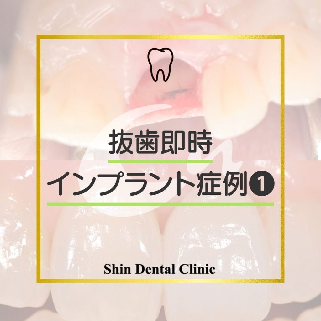 抜歯即時インプラント症例