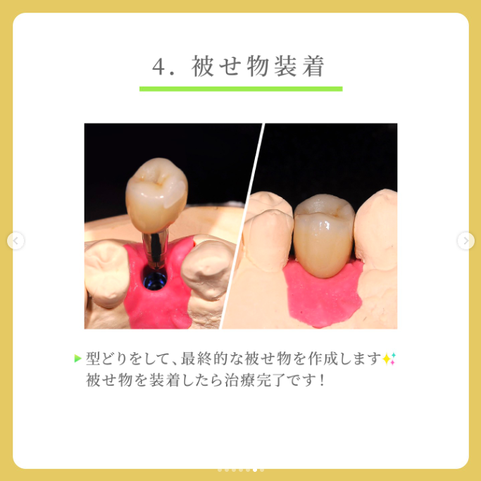 被せ物