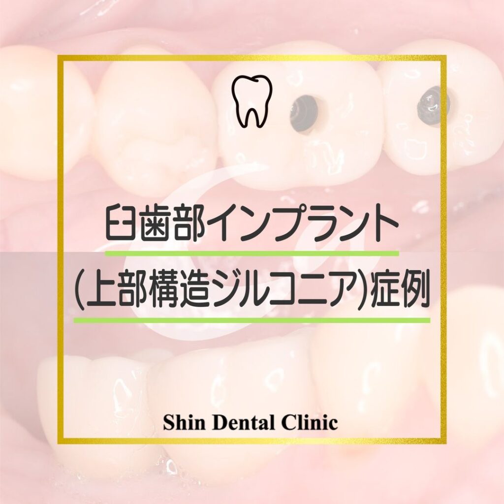 臼歯部インプラント（上部構造ジルコニア）症例