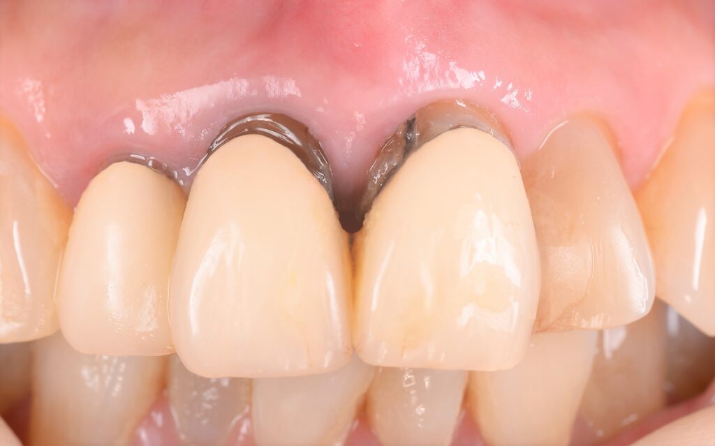 前歯のインプラント治療🦷