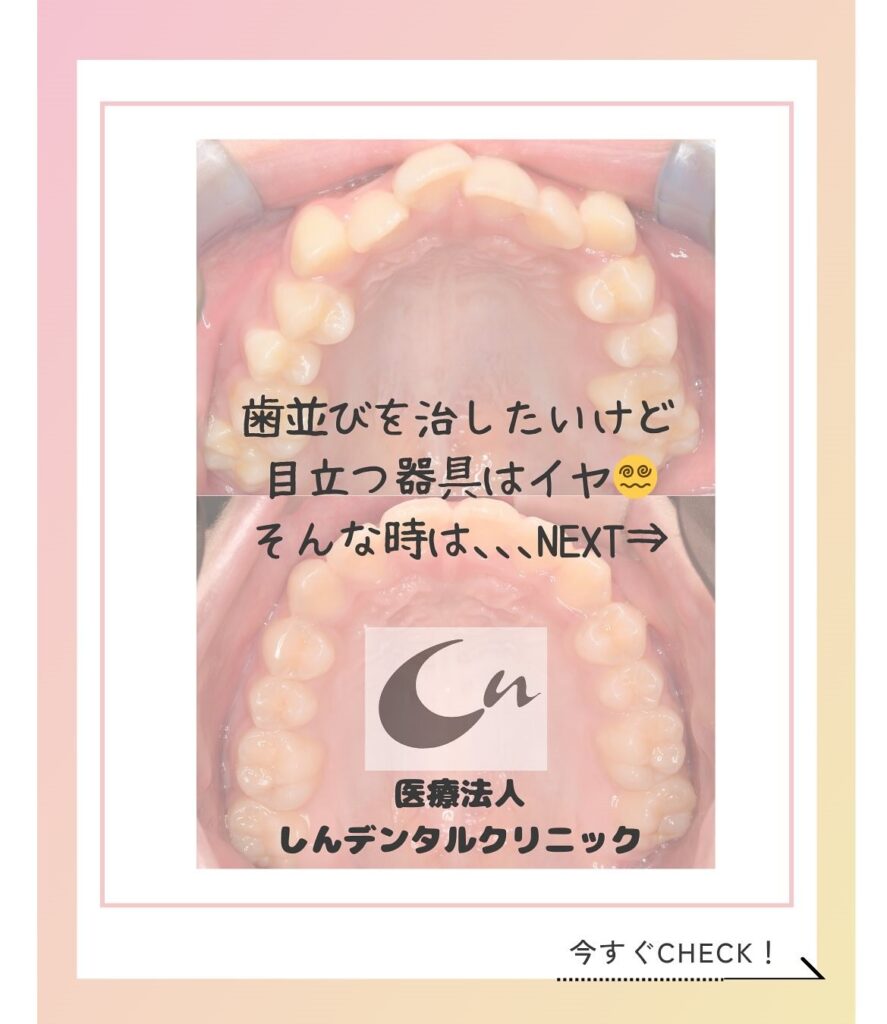 マウスピース矯正