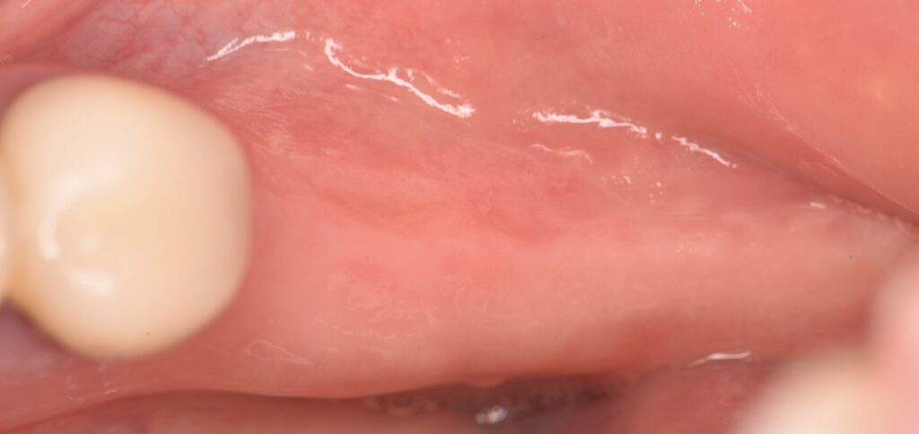 噛める幸せをもう一度✨インプラント治療で快適な毎日へ🌱