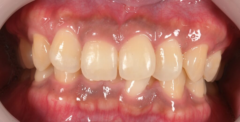 ガムピーリングで笑顔の印象アップ!!✨