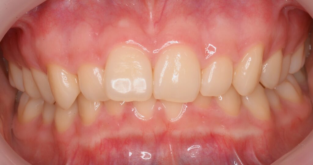 気になる歯並びを部分矯正✨