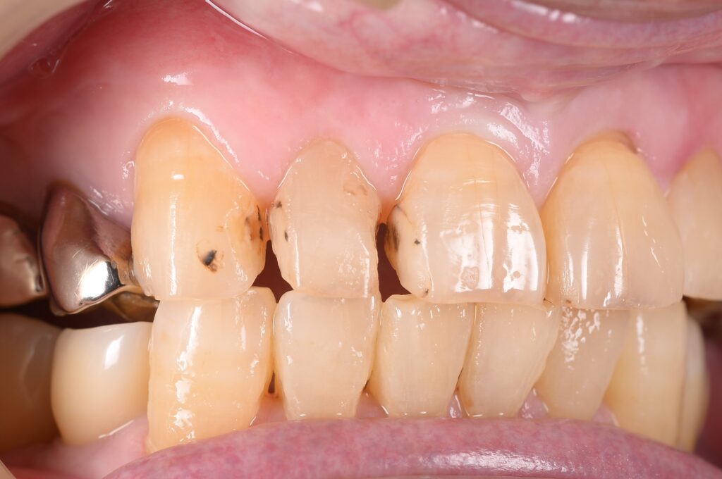 虫歯の治療を一日で完了🦷