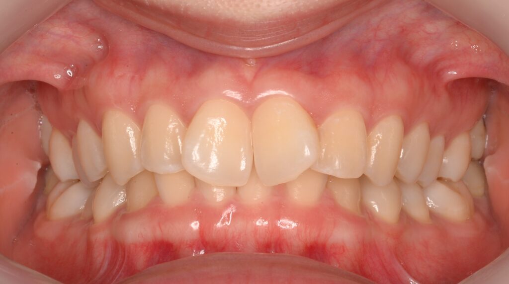 歯科矯正のイメージ変わります❗️マウスピース矯正