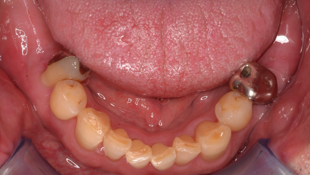 奥歯で噛めるようになった！〜インプラント治療〜