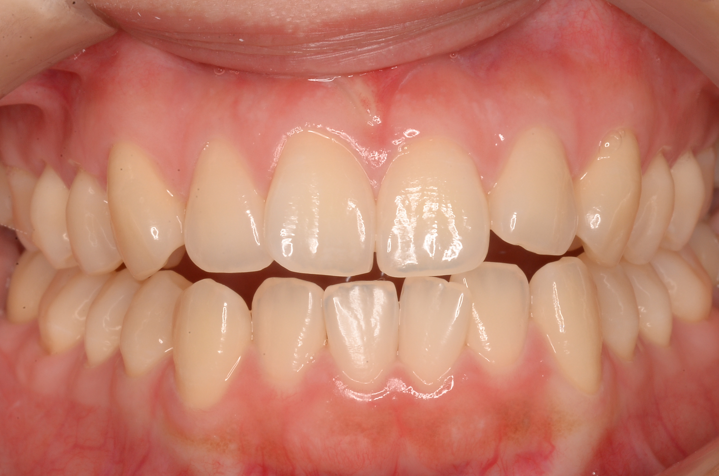 【27歳女性】7ヶ月で前歯の歯並びが改善✨マウスピース矯正（iGO）で手に入れた理想の笑顔